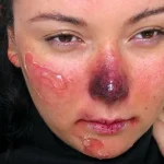 первая помощь при обморожении