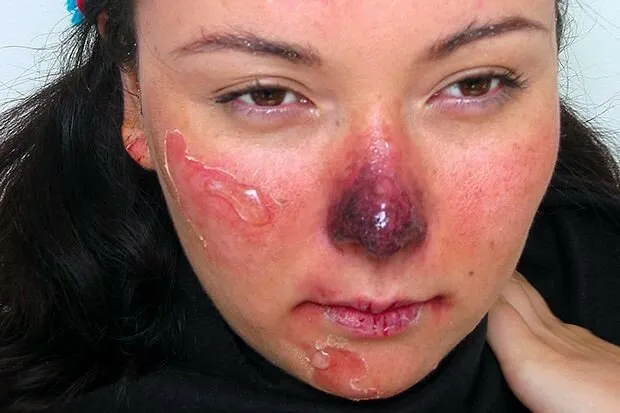 первая помощь при обморожении